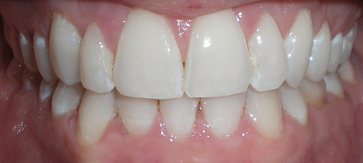 ClearCorrect-2-after