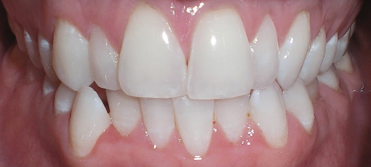ClearCorrect-2-before