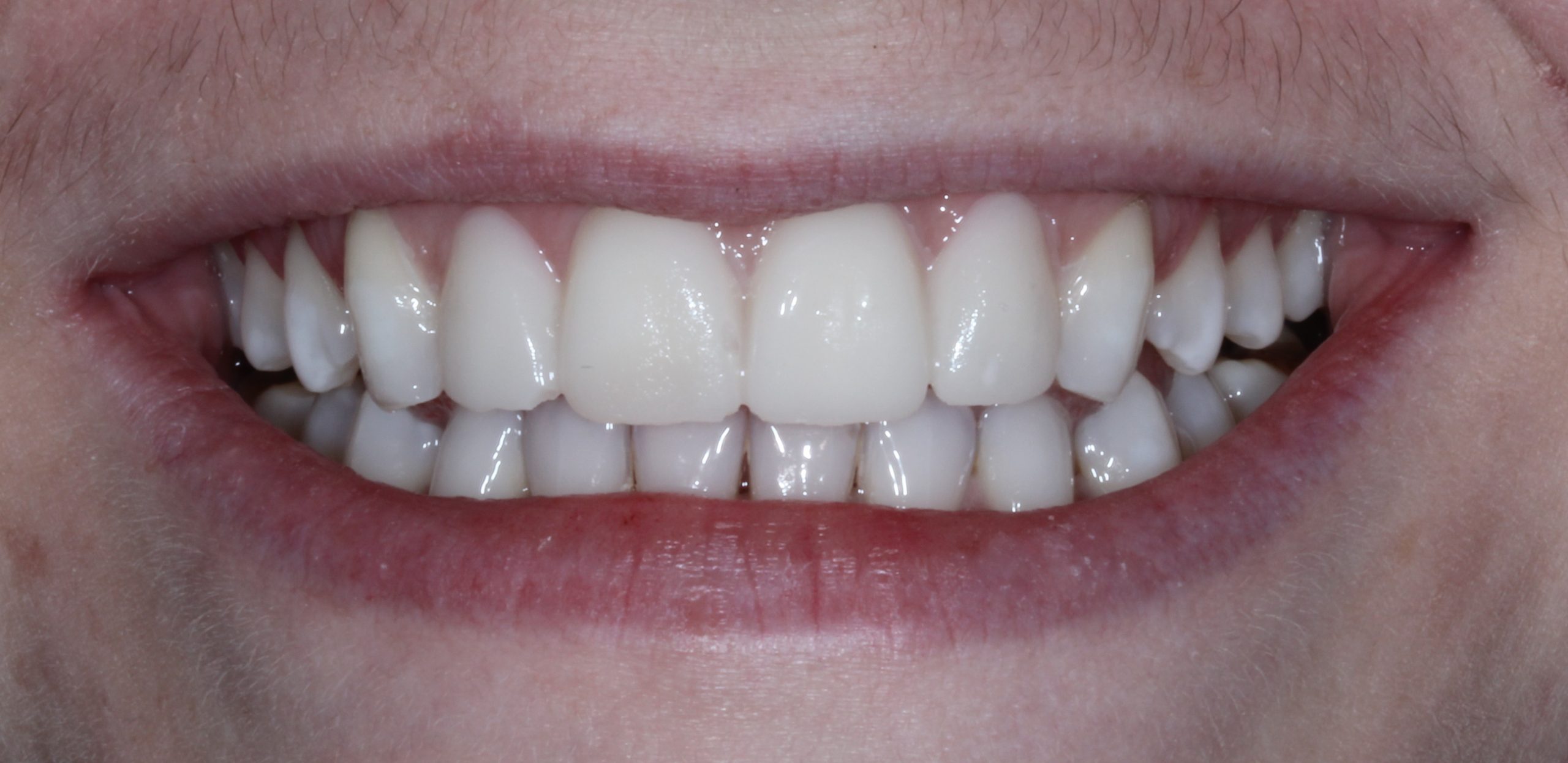 composite-bonding-1-after