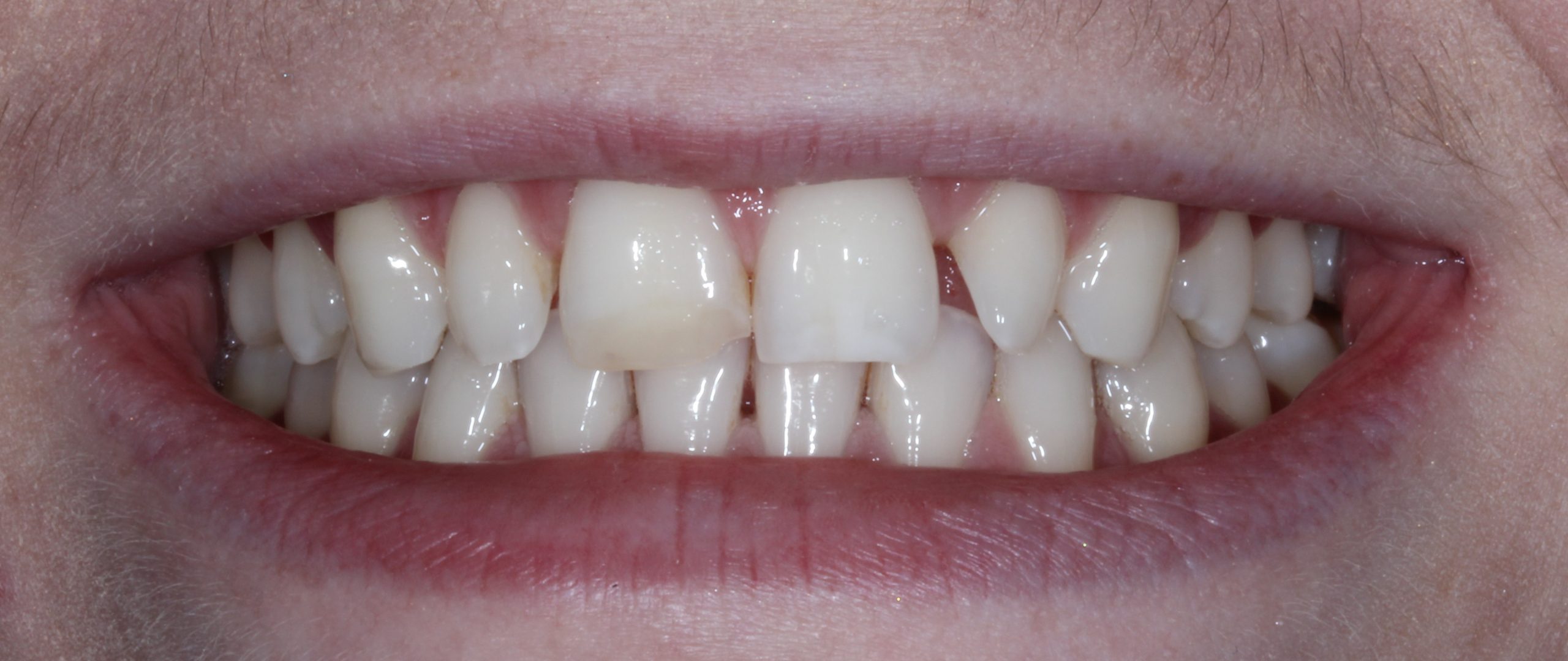 composite-bonding-1-before