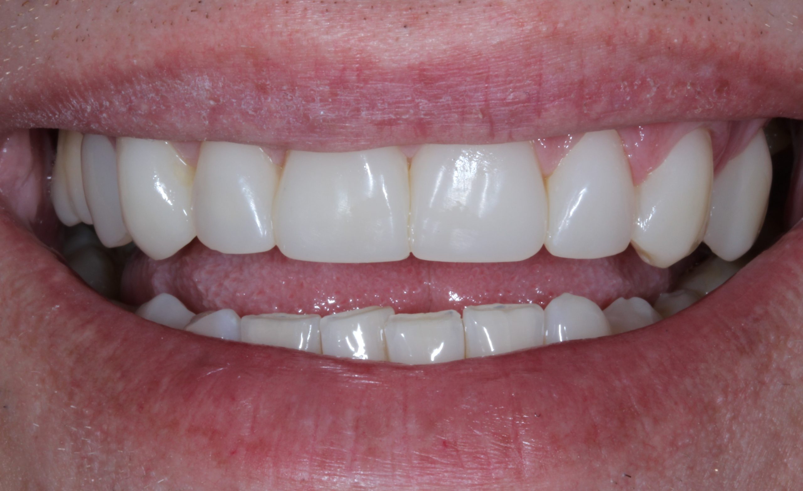composite-bonding-2-after