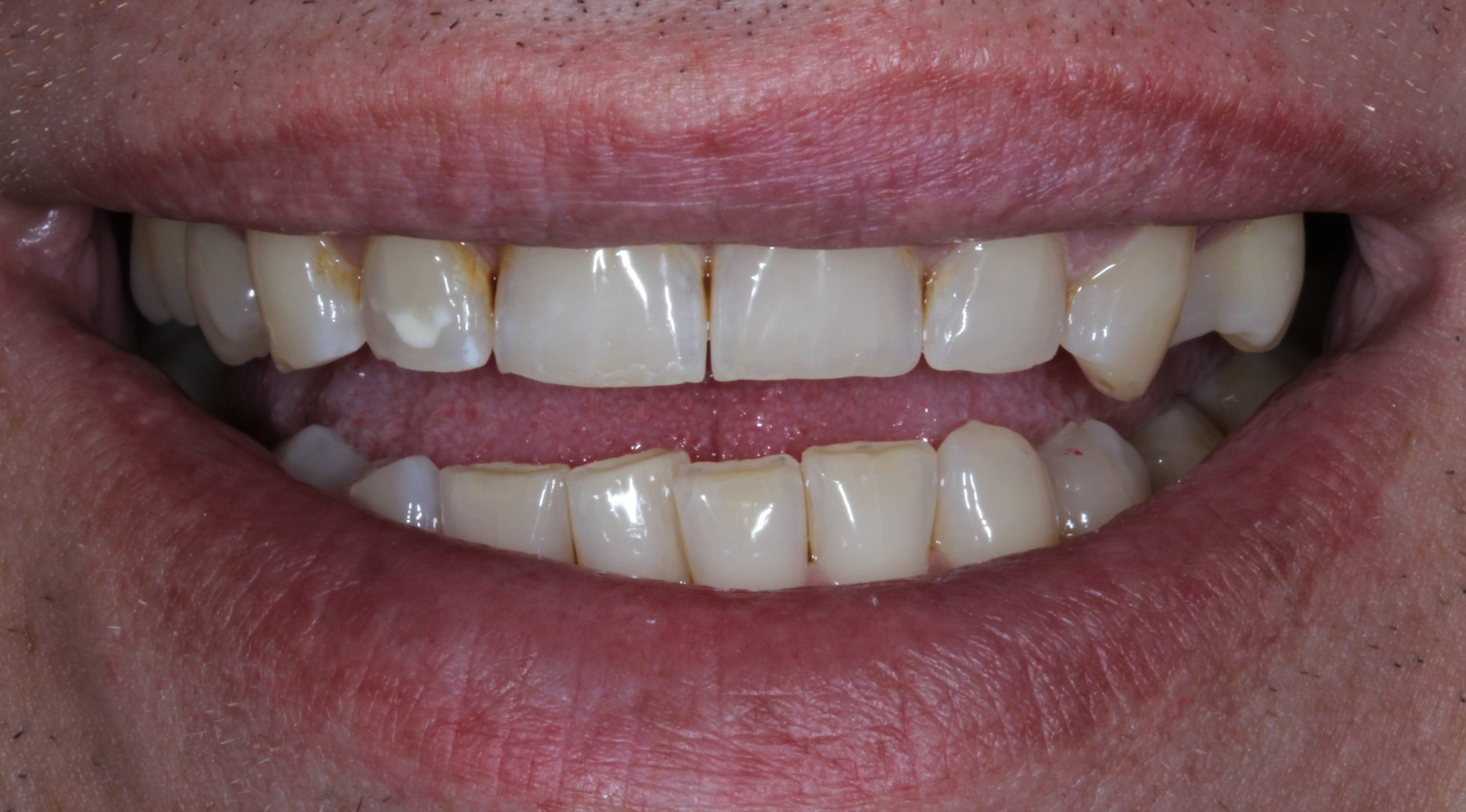 composite-bonding-2-before